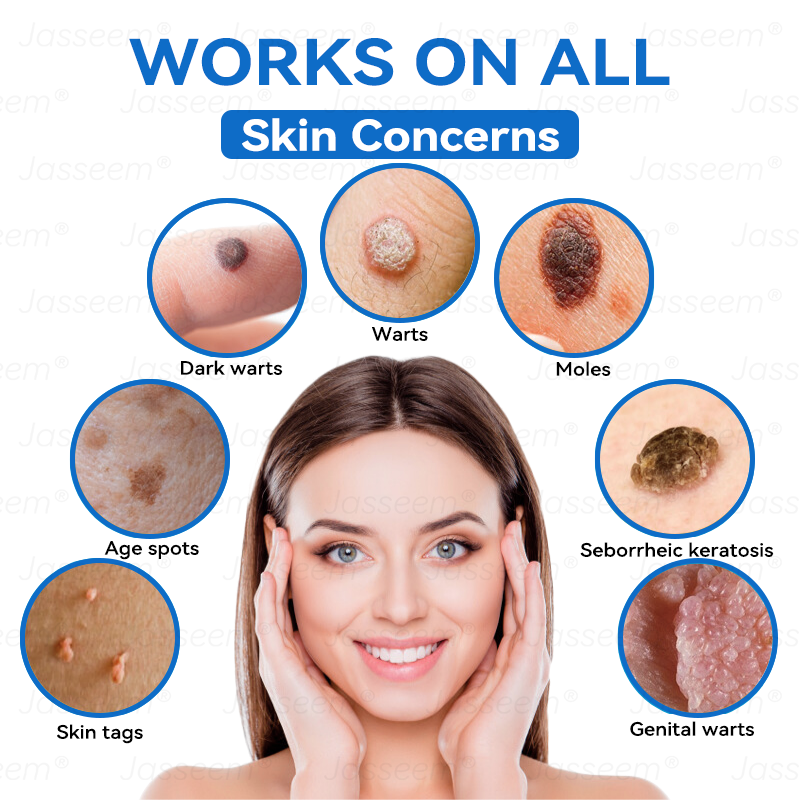 𝐉𝐚𝐬𝐬𝐞𝐞𝐦®👩‍⚕️🎁 𝐍𝐨𝐧-𝐈𝐧𝐯𝐚𝐬𝐢𝐯𝐞 𝐌𝐨𝐥𝐞 & 𝐖𝐚𝐫𝐭 𝐋𝐚𝐬𝐞𝐫 𝐑𝐞𝐦𝐨𝐯𝐚𝐥 𝐏𝐞𝐧 (𝐐𝐮𝐢𝐜𝐤 𝐚𝐧𝐝 𝐩𝐚𝐢𝐧𝐥𝐞𝐬𝐬 𝐫𝐞𝐦𝐨𝐯𝐚𝐥 𝐨𝐟 𝐰𝐚𝐫𝐭𝐬, 𝐦𝐨𝐥𝐞𝐬, 𝐚𝐠𝐞 𝐬𝐩𝐨𝐭𝐬, 𝐚𝐧𝐝 𝐬𝐤𝐢𝐧 𝐭𝐚𝐠𝐬 𝐰𝐢𝐭𝐡 𝐧𝐨 𝐬𝐢𝐝𝐞 𝐞𝐟𝐟𝐞𝐜𝐭𝐬)
