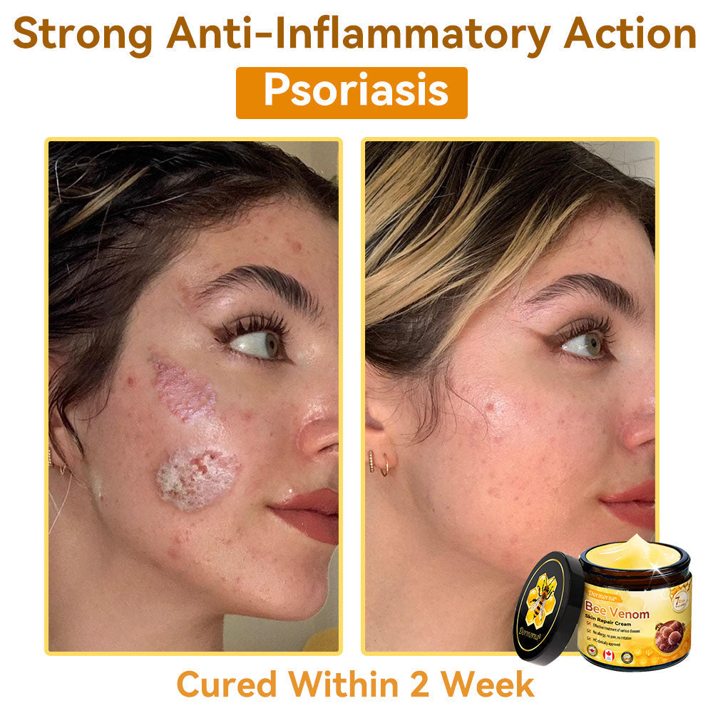 𝐃𝐨𝐫𝐦𝐨𝐫𝐧𝐚®💧Bee Venom Repair Cream (Anti-aging, deep hydration, skin repair, even skin tone, acne and dark spot treatment, removal of warts and moles, and psoriasis relief)