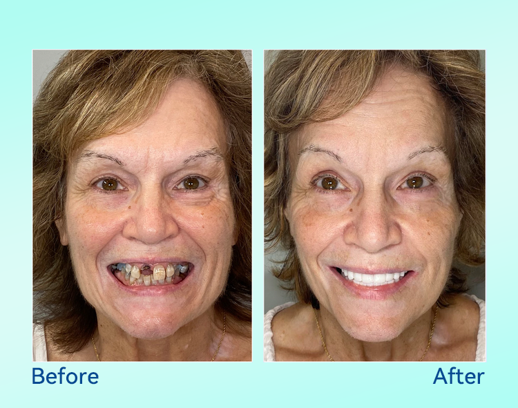 🔥 Only 4 boxes left! Enjoy an extra 50% off! Recommended by dentists, 🍀𝐁𝐢𝐤𝐞𝐧𝐝𝐚® ensures your oral health so you can enjoy meals safely and naturally. Don’t miss out—act now or wait until next year! Enhance your oral health today!