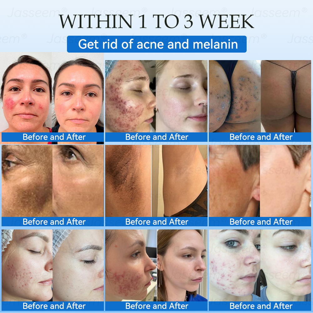 𝐉𝐚𝐬𝐬𝐞𝐞𝐦®👩‍⚕️🎁 𝐍𝐨𝐧-𝐈𝐧𝐯𝐚𝐬𝐢𝐯𝐞 𝐌𝐨𝐥𝐞 & 𝐖𝐚𝐫𝐭 𝐋𝐚𝐬𝐞𝐫 𝐑𝐞𝐦𝐨𝐯𝐚𝐥 𝐏𝐞𝐧 (𝐐𝐮𝐢𝐜𝐤 𝐚𝐧𝐝 𝐩𝐚𝐢𝐧𝐥𝐞𝐬𝐬 𝐫𝐞𝐦𝐨𝐯𝐚𝐥 𝐨𝐟 𝐰𝐚𝐫𝐭𝐬, 𝐦𝐨𝐥𝐞𝐬, 𝐚𝐠𝐞 𝐬𝐩𝐨𝐭𝐬, 𝐚𝐧𝐝 𝐬𝐤𝐢𝐧 𝐭𝐚𝐠𝐬 𝐰𝐢𝐭𝐡 𝐧𝐨 𝐬𝐢𝐝𝐞 𝐞𝐟𝐟𝐞𝐜𝐭𝐬)