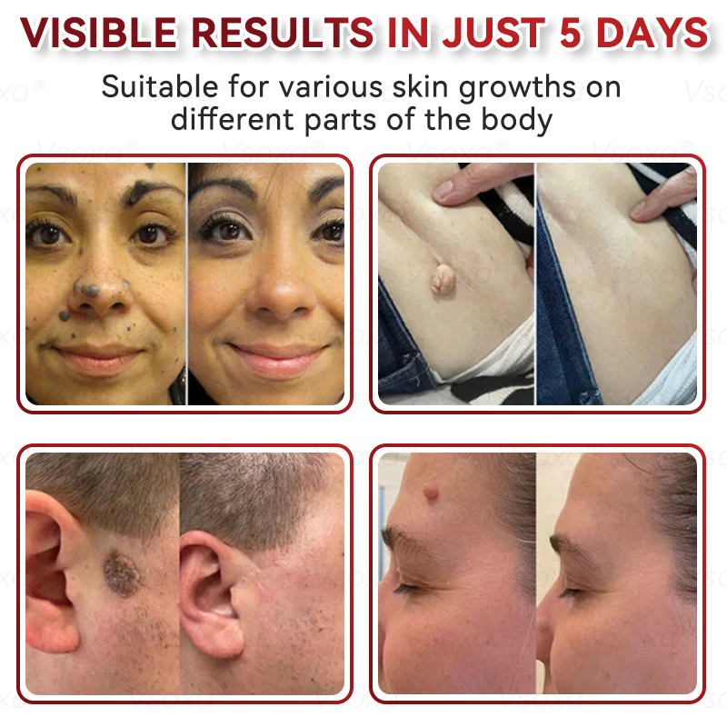 🛡️ 𝑉𝑠𝑜𝑥𝑎® 💕 Microneedle Botanical Skin Tag Repair Patches (Painless, scar‑free, fast removal of various blemishes and acne)👩‍⚕️