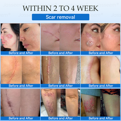 𝐉𝐚𝐬𝐬𝐞𝐞𝐦®👩‍⚕️🎁 𝐍𝐨𝐧-𝐈𝐧𝐯𝐚𝐬𝐢𝐯𝐞 𝐌𝐨𝐥𝐞 & 𝐖𝐚𝐫𝐭 𝐋𝐚𝐬𝐞𝐫 𝐑𝐞𝐦𝐨𝐯𝐚𝐥 𝐏𝐞𝐧 (𝐐𝐮𝐢𝐜𝐤 𝐚𝐧𝐝 𝐩𝐚𝐢𝐧𝐥𝐞𝐬𝐬 𝐫𝐞𝐦𝐨𝐯𝐚𝐥 𝐨𝐟 𝐰𝐚𝐫𝐭𝐬, 𝐦𝐨𝐥𝐞𝐬, 𝐚𝐠𝐞 𝐬𝐩𝐨𝐭𝐬, 𝐚𝐧𝐝 𝐬𝐤𝐢𝐧 𝐭𝐚𝐠𝐬 𝐰𝐢𝐭𝐡 𝐧𝐨 𝐬𝐢𝐝𝐞 𝐞𝐟𝐟𝐞𝐜𝐭𝐬)