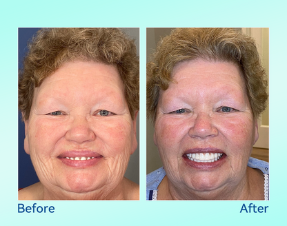 🔥 Only 4 boxes left! Enjoy an extra 50% off! Recommended by dentists, 🍀𝐁𝐢𝐤𝐞𝐧𝐝𝐚® ensures your oral health so you can enjoy meals safely and naturally. Don’t miss out—act now or wait until next year! Enhance your oral health today!