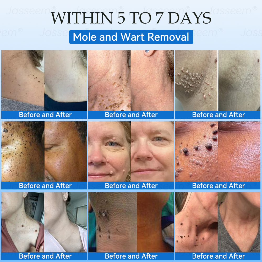 𝐉𝐚𝐬𝐬𝐞𝐞𝐦®👩‍⚕️🎁 𝐍𝐨𝐧-𝐈𝐧𝐯𝐚𝐬𝐢𝐯𝐞 𝐌𝐨𝐥𝐞 & 𝐖𝐚𝐫𝐭 𝐋𝐚𝐬𝐞𝐫 𝐑𝐞𝐦𝐨𝐯𝐚𝐥 𝐏𝐞𝐧 (𝐐𝐮𝐢𝐜𝐤 𝐚𝐧𝐝 𝐩𝐚𝐢𝐧𝐥𝐞𝐬𝐬 𝐫𝐞𝐦𝐨𝐯𝐚𝐥 𝐨𝐟 𝐰𝐚𝐫𝐭𝐬, 𝐦𝐨𝐥𝐞𝐬, 𝐚𝐠𝐞 𝐬𝐩𝐨𝐭𝐬, 𝐚𝐧𝐝 𝐬𝐤𝐢𝐧 𝐭𝐚𝐠𝐬 𝐰𝐢𝐭𝐡 𝐧𝐨 𝐬𝐢𝐝𝐞 𝐞𝐟𝐟𝐞𝐜𝐭𝐬)