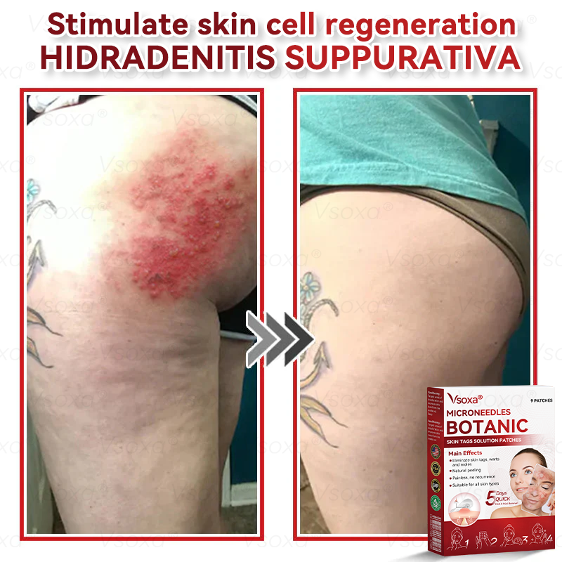 🛡️ 𝑉𝑠𝑜𝑥𝑎®  Microneedle Botanical Skin Tag Repair Patches 🎁🎁