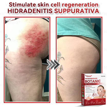 🛡️ 𝑉𝑠𝑜𝑥𝑎®  Microneedle Botanical Skin Tag Repair Patches 🎁🎁