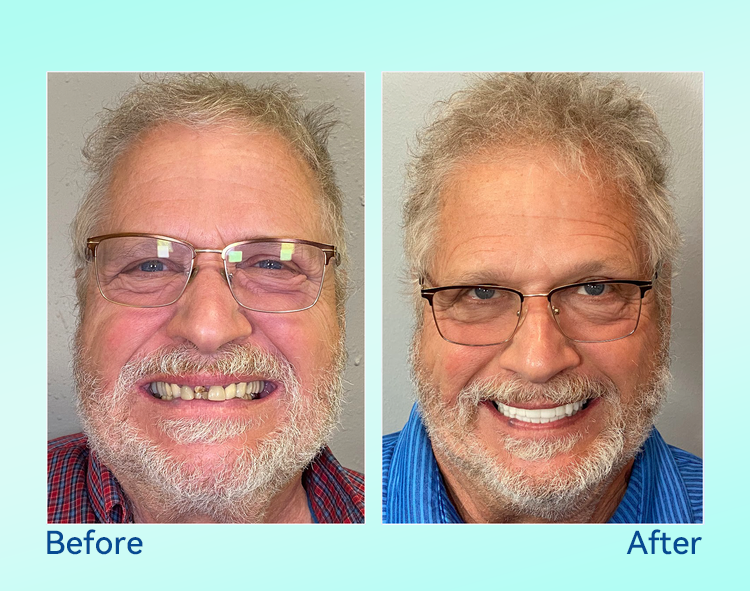 🔥 Only 4 boxes left! Enjoy an extra 50% off! Recommended by dentists, 🍀𝐁𝐢𝐤𝐞𝐧𝐝𝐚® ensures your oral health so you can enjoy meals safely and naturally. Don’t miss out—act now or wait until next year! Enhance your oral health today!