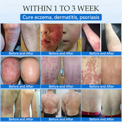𝐉𝐚𝐬𝐬𝐞𝐞𝐦®👩‍⚕️🎁 𝐍𝐨𝐧-𝐈𝐧𝐯𝐚𝐬𝐢𝐯𝐞 𝐌𝐨𝐥𝐞 & 𝐖𝐚𝐫𝐭 𝐋𝐚𝐬𝐞𝐫 𝐑𝐞𝐦𝐨𝐯𝐚𝐥 𝐏𝐞𝐧 (𝐐𝐮𝐢𝐜𝐤 𝐚𝐧𝐝 𝐩𝐚𝐢𝐧𝐥𝐞𝐬𝐬 𝐫𝐞𝐦𝐨𝐯𝐚𝐥 𝐨𝐟 𝐰𝐚𝐫𝐭𝐬, 𝐦𝐨𝐥𝐞𝐬, 𝐚𝐠𝐞 𝐬𝐩𝐨𝐭𝐬, 𝐚𝐧𝐝 𝐬𝐤𝐢𝐧 𝐭𝐚𝐠𝐬 𝐰𝐢𝐭𝐡 𝐧𝐨 𝐬𝐢𝐝𝐞 𝐞𝐟𝐟𝐞𝐜𝐭𝐬)