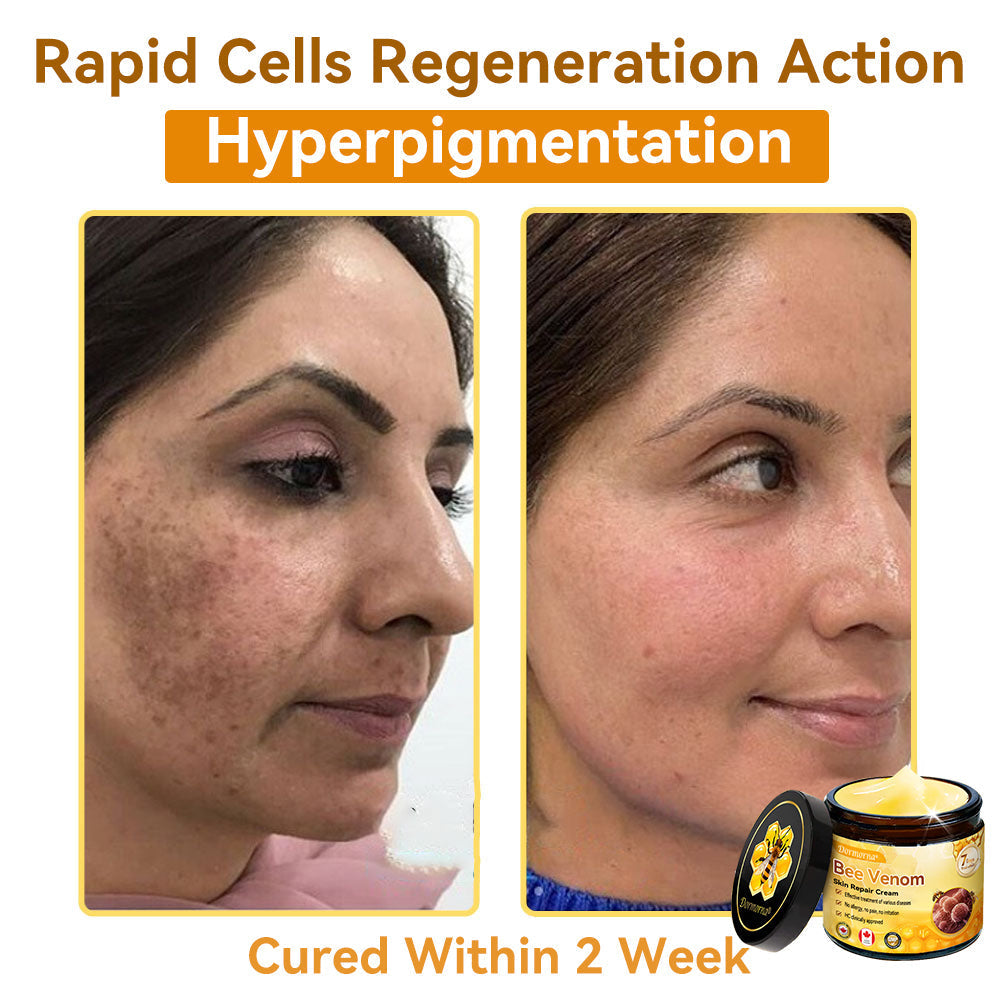 𝐃𝐨𝐫𝐦𝐨𝐫𝐧𝐚®💧Bee Venom Repair Cream (Anti-aging, deep hydration, skin repair, even skin tone, acne and dark spot treatment, removal of warts and moles, and psoriasis relief)
