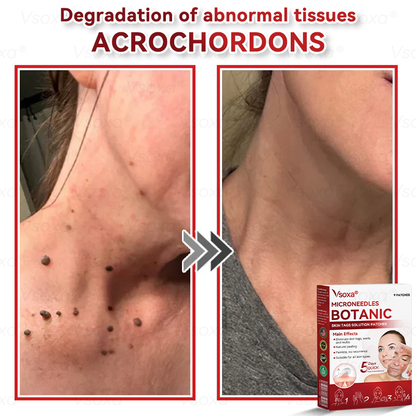 🛡️ 𝑉𝑠𝑜𝑥𝑎® 💕 Microneedle Botanical Skin Tag Repair Patches (Painless, scar‑free, fast removal of various blemishes and acne)👩‍⚕️