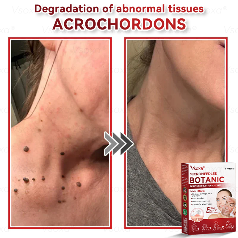 𝑉𝑠𝑜𝑥𝑎® 💧Microneedles Botanical Skin Tags Solution Patches - Made in the USA