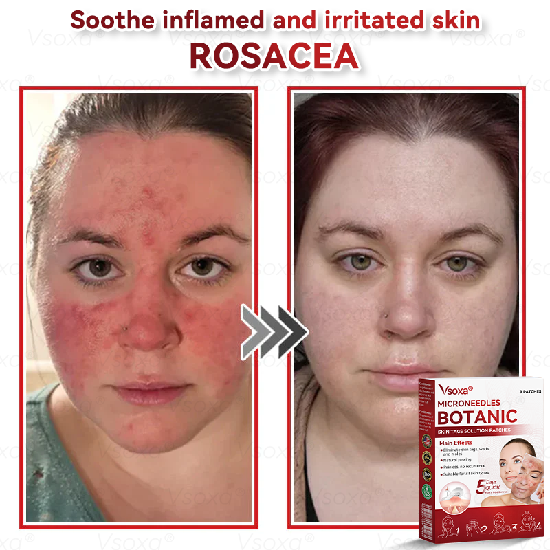 𝑉𝑠𝑜𝑥𝑎® 💧Microneedles Botanical Skin Tags Solution Patches - Made in the USA