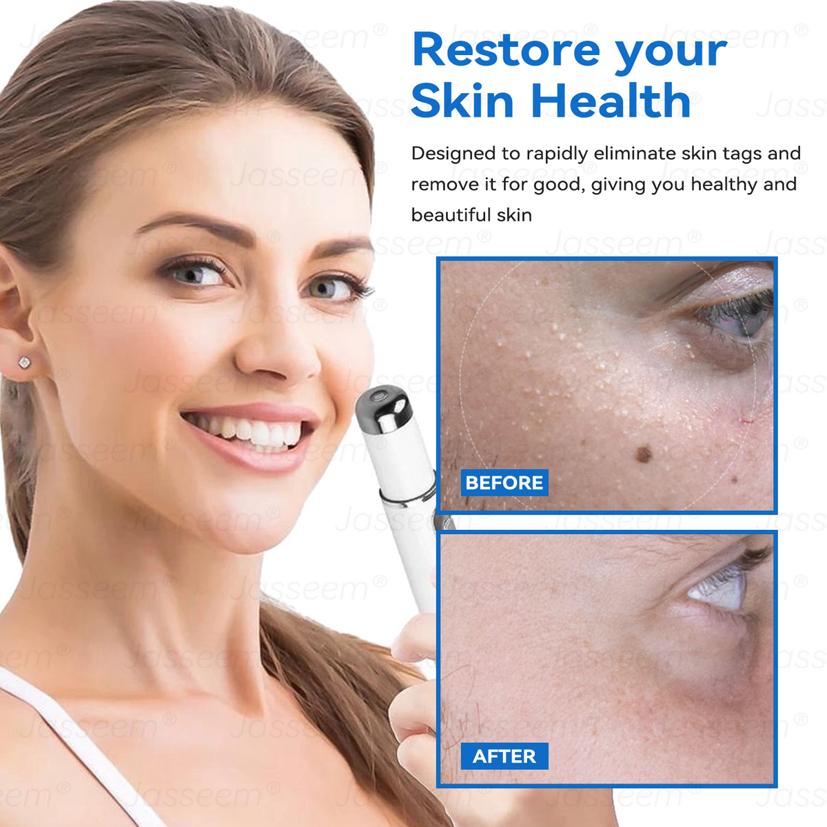 𝐉𝐚𝐬𝐬𝐞𝐞𝐦® 𝐍𝐨𝐧-𝐈𝐧𝐯𝐚𝐬𝐢𝐯𝐞 𝐌𝐨𝐥𝐞 & 𝐖𝐚𝐫𝐭 𝐋𝐚𝐬𝐞𝐫 𝐑𝐞𝐦𝐨𝐯𝐚𝐥 𝐏𝐞𝐧 (𝐐𝐮𝐢𝐜𝐤 𝐚𝐧𝐝 𝐩𝐚𝐢𝐧𝐥𝐞𝐬𝐬 𝐫𝐞𝐦𝐨𝐯𝐚𝐥 𝐨𝐟 𝐰𝐚𝐫𝐭𝐬, 𝐦𝐨𝐥𝐞𝐬, 𝐚𝐠𝐞 𝐬𝐩𝐨𝐭𝐬, 𝐚𝐧𝐝 𝐬𝐤𝐢𝐧 𝐭𝐚𝐠𝐬 𝐰𝐢𝐭𝐡 𝐧𝐨 𝐬𝐢𝐝𝐞 𝐞𝐟𝐟𝐞𝐜𝐭𝐬)