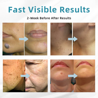 𝐉𝐚𝐬𝐬𝐞𝐞𝐦® Medical-Grade Laser Pen 🎉 (Powered by CO₂ laser technology – effectively removes moles, warts, skin tags, pigmentation spots, and other skin imperfections)🏆