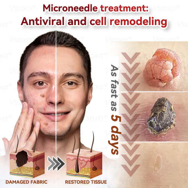 🛡️ 𝑉𝑠𝑜𝑥𝑎® 💕 Microneedle Botanical Skin Tag Repair Patches (Painless, scar‑free, fast removal of various blemishes and acne)👩‍⚕️