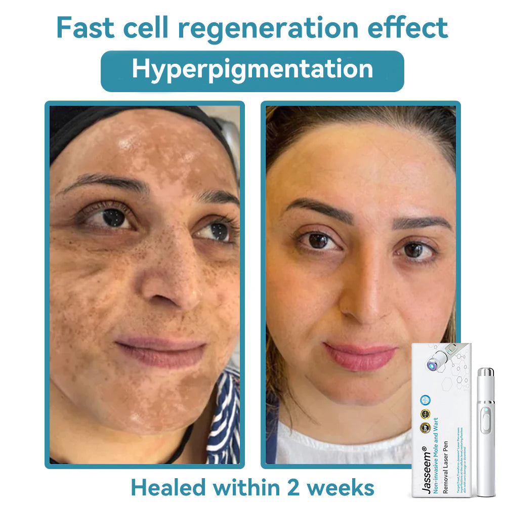 𝐉𝐚𝐬𝐬𝐞𝐞𝐦® Medical-Grade Laser Pen 🎉 (Powered by CO₂ laser technology – effectively removes moles, warts, skin tags, pigmentation spots, and other skin imperfections)🔥