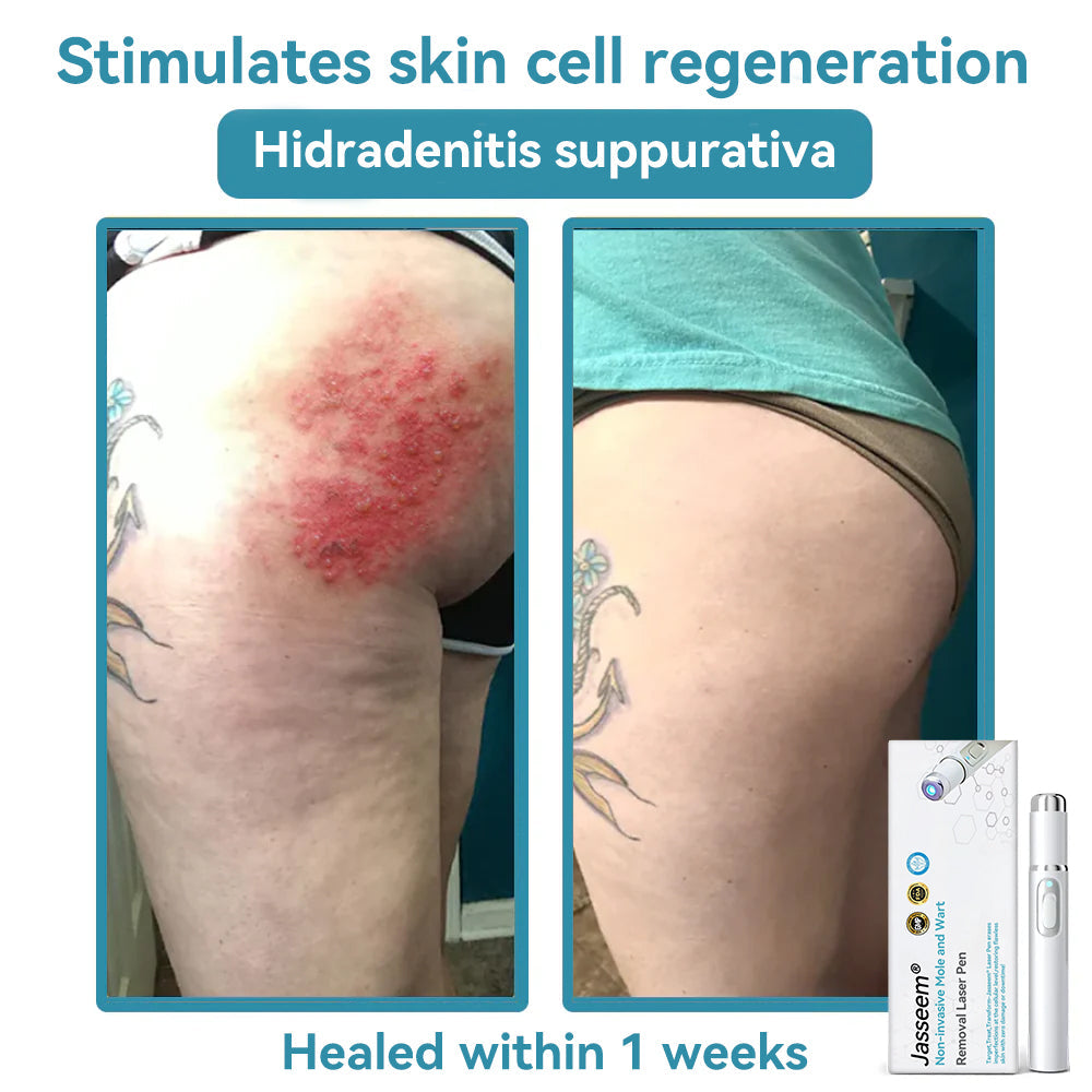 𝐉𝐚𝐬𝐬𝐞𝐞𝐦® Medical-Grade Laser Pen 🎉 (Powered by CO₂ laser technology – effectively removes moles, warts, skin tags, pigmentation spots, and other skin imperfections)🔥