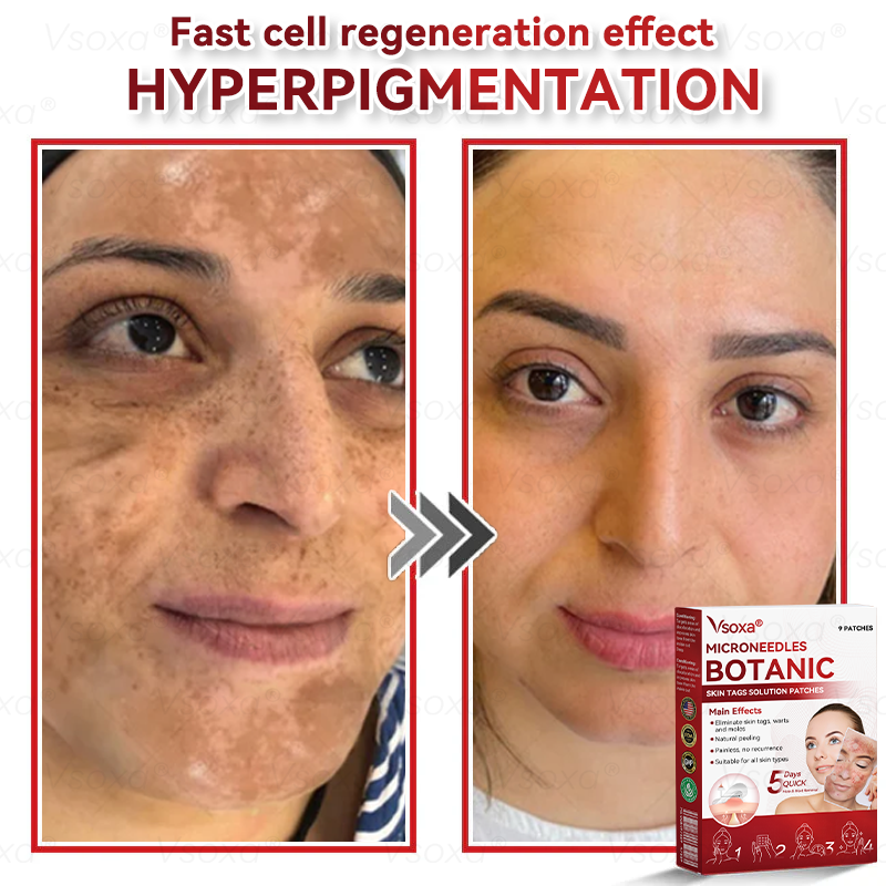 🛡️ 𝑉𝑠𝑜𝑥𝑎®  Microneedle Botanical Skin Tag Repair Patches 🎁🎁