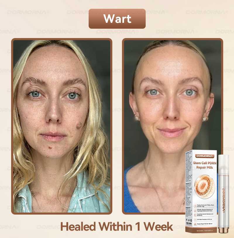 𝐷𝑂𝑅𝑀𝑂𝑅𝑁𝐴® 💕 Stem Cell PDRN Repair Milk | With 2000PPM Exosome‑Coated Micro‑Spicules 👩‍⚕️