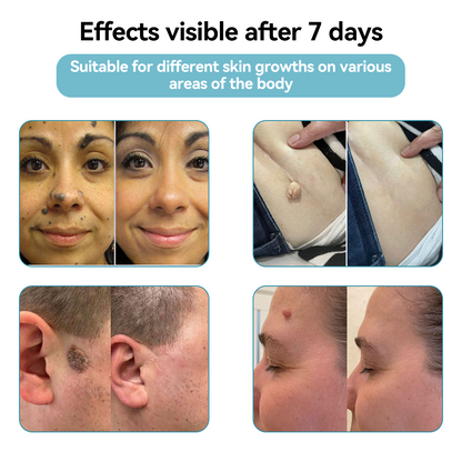 𝐉𝐚𝐬𝐬𝐞𝐞𝐦® Medical-Grade Laser Pen 🎉 (Powered by CO₂ laser technology – effectively removes moles, warts, skin tags, pigmentation spots, and other skin imperfections)🏆