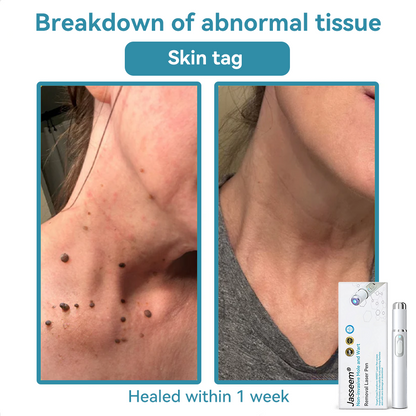 𝐉𝐚𝐬𝐬𝐞𝐞𝐦® Medical-Grade Laser Pen 🎉 (Powered by CO₂ laser technology – effectively removes moles, warts, skin tags, pigmentation spots, and other skin imperfections)🏆