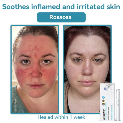 𝐉𝐚𝐬𝐬𝐞𝐞𝐦® Medical-Grade Laser Pen 🎉 (Powered by CO₂ laser technology – effectively removes moles, warts, skin tags, pigmentation spots, and other skin imperfections)🔥