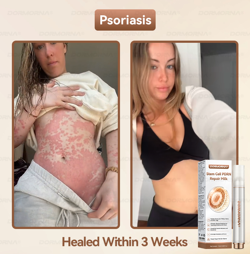 Dormorna® Stem Cell PDRN Repair Milk 💕 | With 2000PPM Exosome‑Coated Micro‑Spicules 🏆