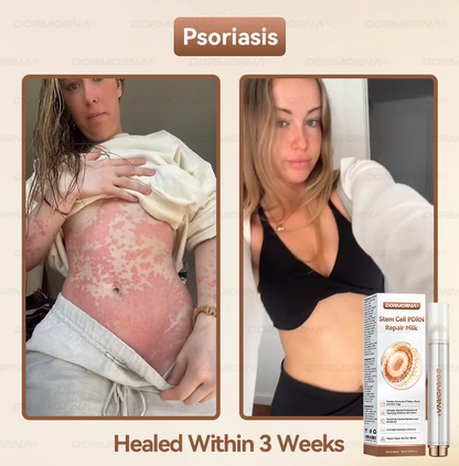 Dormorna® Stem Cell PDRN Repair Milk 💕 | With 2000PPM Exosome‑Coated Micro‑Spicules 🏆