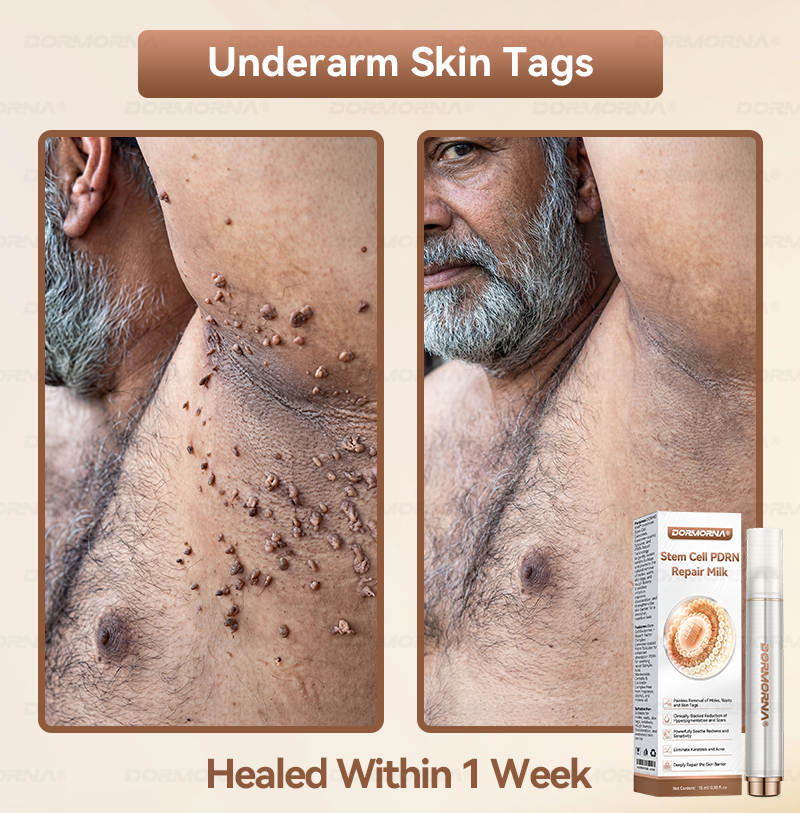 Dormorna® Stem Cell PDRN Repair Milk 💕 | With 2000PPM Exosome‑Coated Micro‑Spicules 🏆